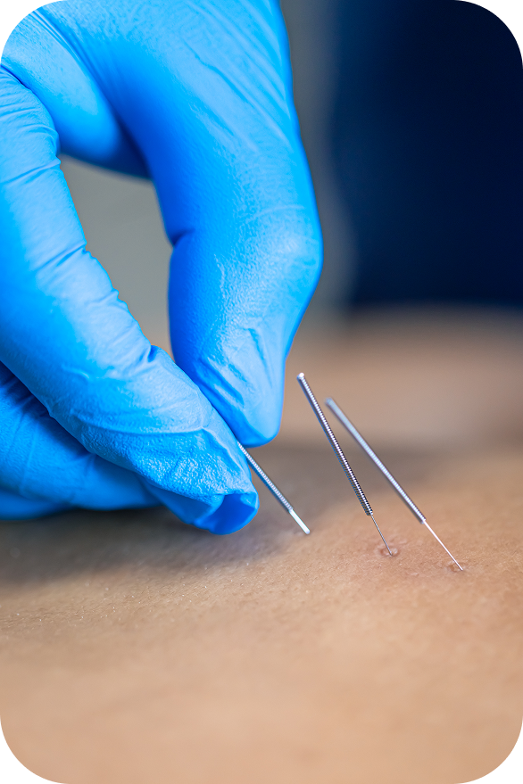 A close-up view of a medical professional's gloved hand gently inserting fine acupuncture needles into a patient's skin for pain relief.